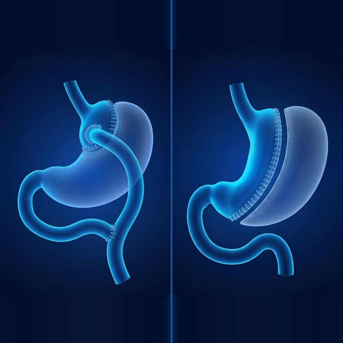 Cirurgia Bariátrica e Metabólica